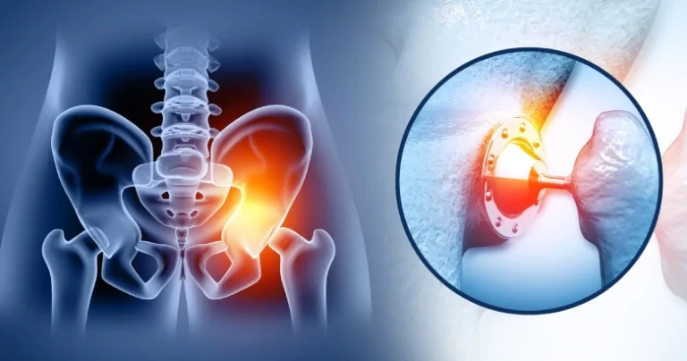 Minimally Invasive Hip Replacement: Small Incision, Big Impact